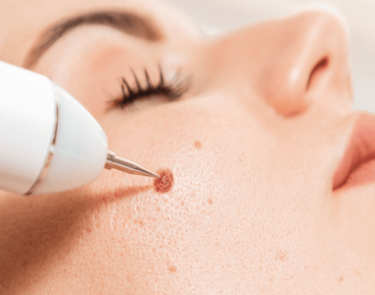 mole or skin tag removal