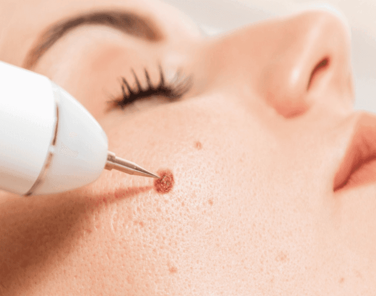 Mole / Skin Tag Removal
